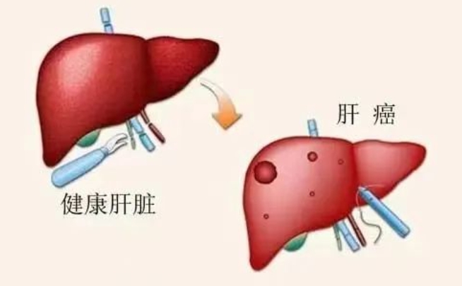 五院專家講堂 | 肝病患者定期復(fù)查彩超的重要性