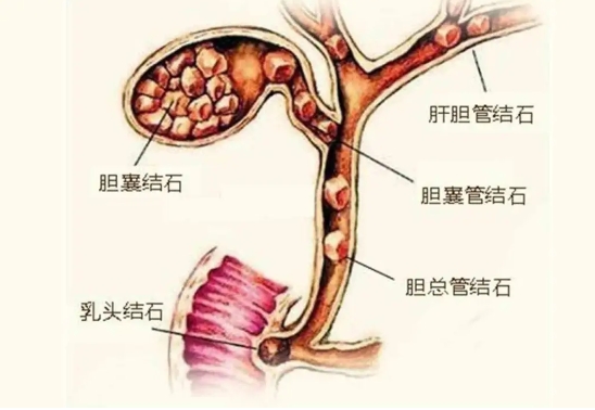 市五院多學科聯動 ERCP治療七旬膽梗阻患者化“阻”為通